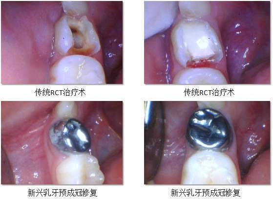 儿童牙齿“小钢炮”，儿童乳牙保护伞，儿童“预成冠”究竟是什么？