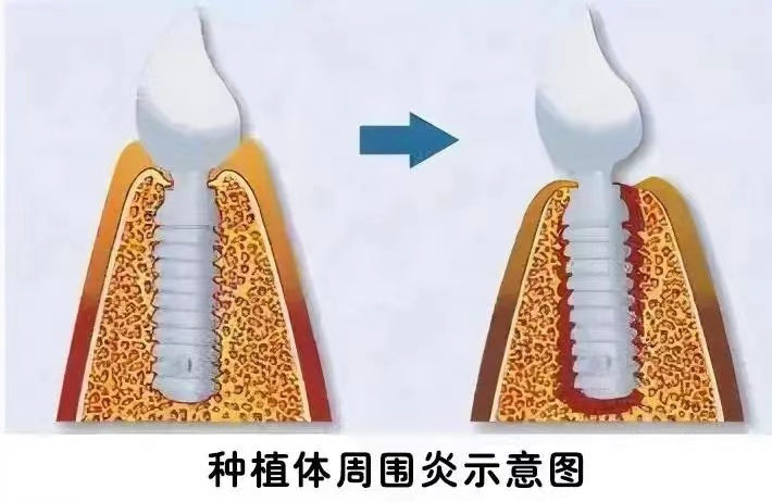 种植手术过后为啥不敢吸烟？