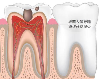 牙疼忍忍就能过去吗？牙疼不治真的可能会要人命！